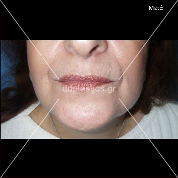 After-Διόρθωση ρυτίδων άνω χείλους