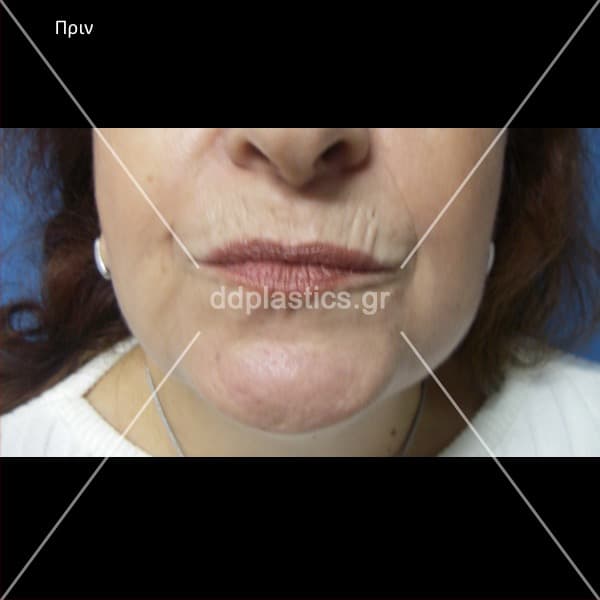 Before-Διόρθωση ρυτίδων άνω χείλους