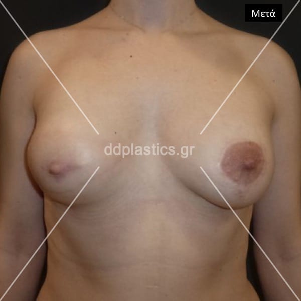 After-Αποκατάσταση ΔΕ μαστού με κρημνό από την πλάτη, ανάπλαση θηλής και συμμετρικοποίηση ΑΡ μαστού