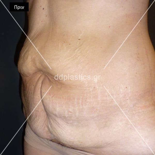 Before-ted