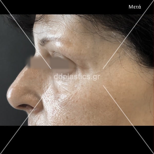 After-ted