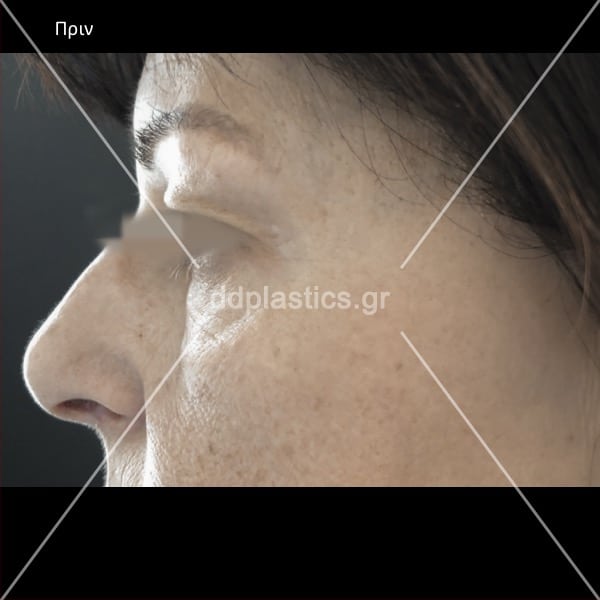 Before-ted