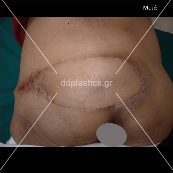 After-ped