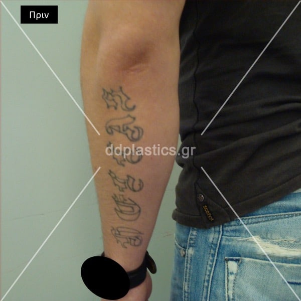 Before-epd